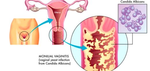 candida-albicans